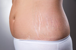 What are stretch marks?